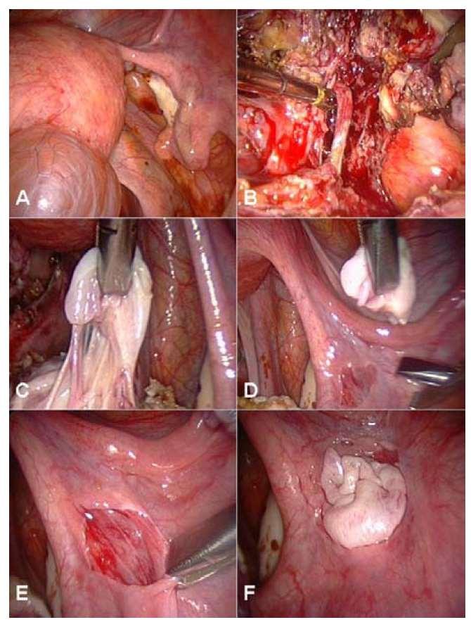 Orthotopic transplantation of fresh