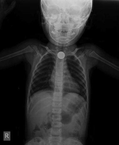 Use of Magill Forceps to Remove FBs in Children Oncel et al. e93 Fig. 5 X-ray shows a coin in the first part of the esophagus. recorded.