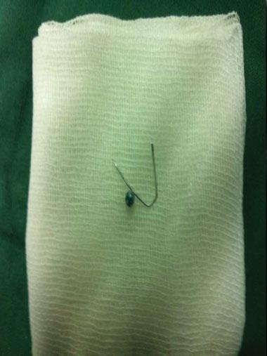 Magill forceps were advanced into the esophagus and opened to observe and extract the FB.