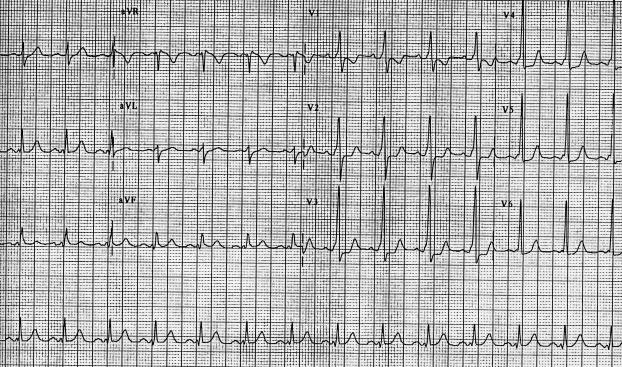 V4 Afib in WPW usually wide-complex and very fast (~300) Afib in WPW can lead to Vfib slowing conduction through the A-V node with B-blockers etc.