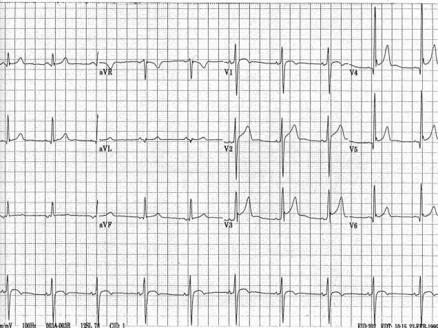 8 Hyperkalemia EKG changes more reflective of rate of rise rather than absolute