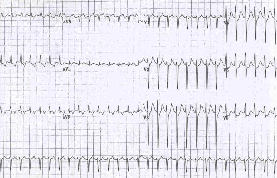6 Paroxysmal Supraventricular Tachycardia (PSVT) Atrial rhythm: narrow QRS (usually) Paroxysmal Rate 140-250 AVRT AVNRT Atrial tachycardia Paroxysmal Supraventricular Tachycardia (PSVT)