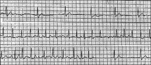 Sick Sinus Syndrome Disorders of impulse generation and conduction Failure of escape pacemakers Susceptibility to atrial tachyarrhythmia s Bradycardia / tachycardia syndrome Long pause after