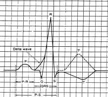 delta wave on the EKG Fusion beat Short PR Wider than normal QRS 113 Delta Wave of Pre-excitation Syndrome 60 to 70% of WPW shows