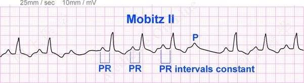 2 nd Degree Type II Both of these examples: 1. One P wave at a time fails to conduct 2. There is a fixed PR interval 3.