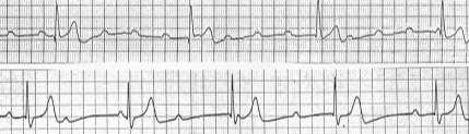 Third Degree AV Block Complete No atrial impulses are conducted to the ventricles One form of AV dissociation Ventricular Rate: