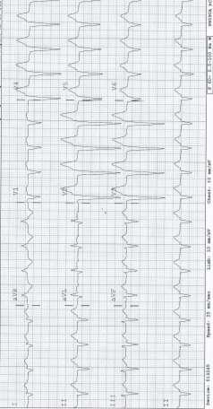 Practice ECG 11 AV Dissociation or Negative Concordance 12 Lead ECG Post Inferior Extreme STEMI on Axis Arrival or V6 to Negative CCU Vital Signs Stable 12 lead ECG