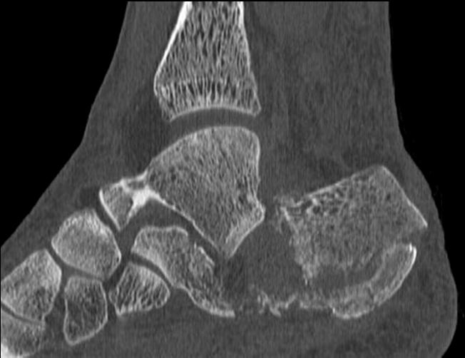 Computed Tomography (CT) Cross sectional