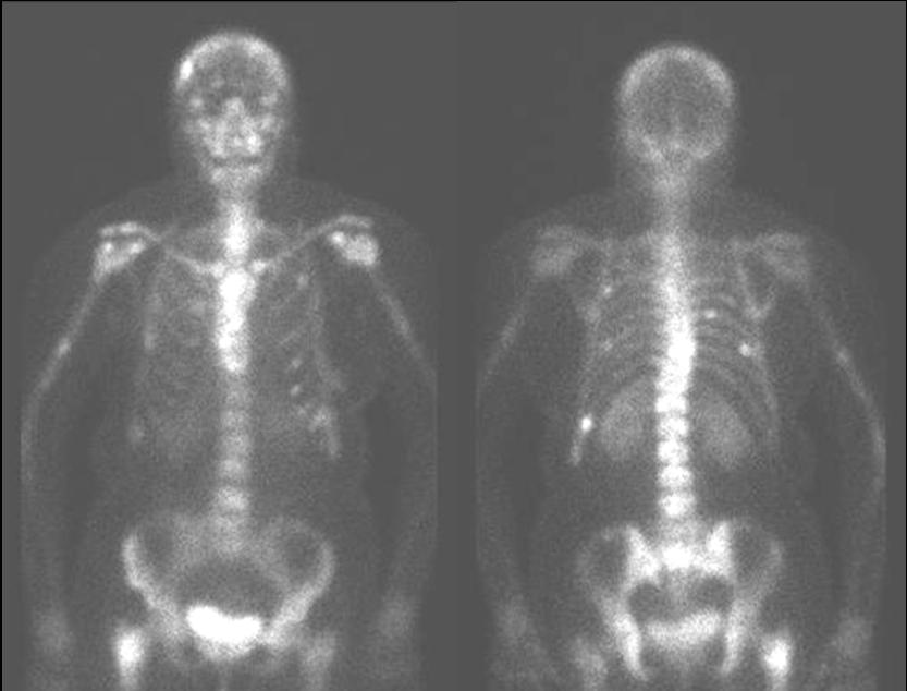 Nuclear Medicine entire skeleton at once bone scan
