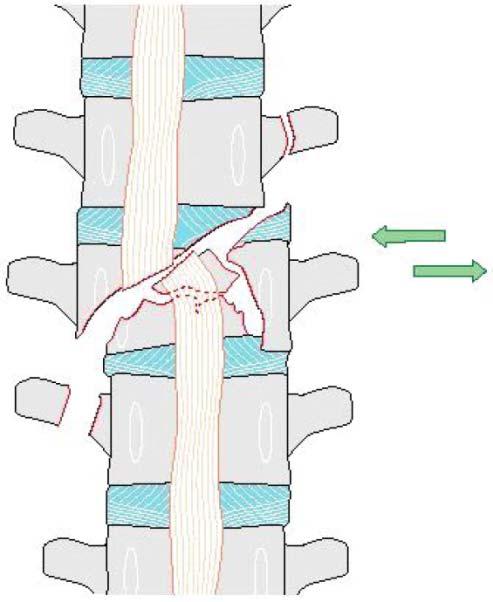 thoracolumbar spinal fractures occur in the