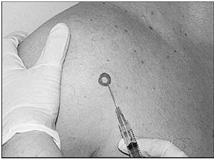Locate coracoid process Locate point of maximal tenderness Insert needle