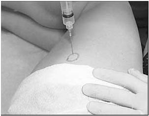 to bone Aspirate fluid prior to injection Withdraw 5 mm; Inject 2 to 3 cc