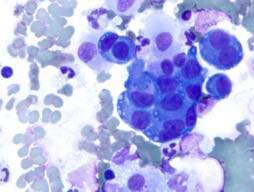How many pathologists are willing to diagnose mesothelioma in effusion cytology specimens?