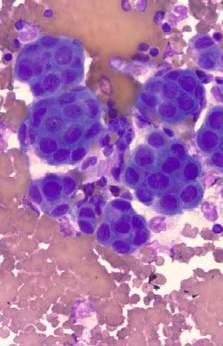 Cancer Cytopath 2013 DIAGNOSIS OF MM IN EFFUSION SAMPLES Mesothelioma Reactive mesothelial cells NO Inability to assess stromal