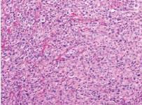 of mesothelial tumors HISTOLOGICAL