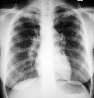 Okada et al concluded that a chest radiograph and serum angiotensin-converting enzyme (ACE) levels sufficiently reflect disease activity and that, at present, routine evaluation with 67 Ga scanning