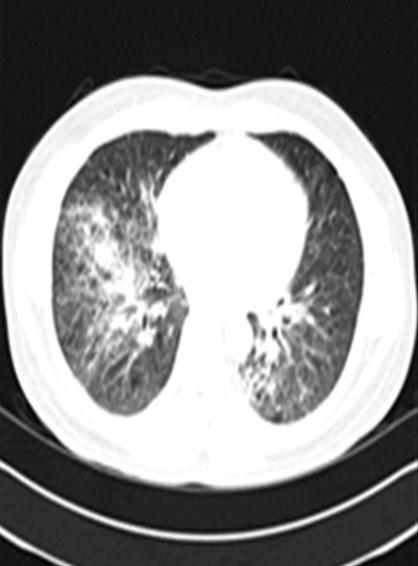 ill-defined nodules in both lungs, along with increased size of the multiple enlarged hilar and interlobar lymph nodes. Figure 4.