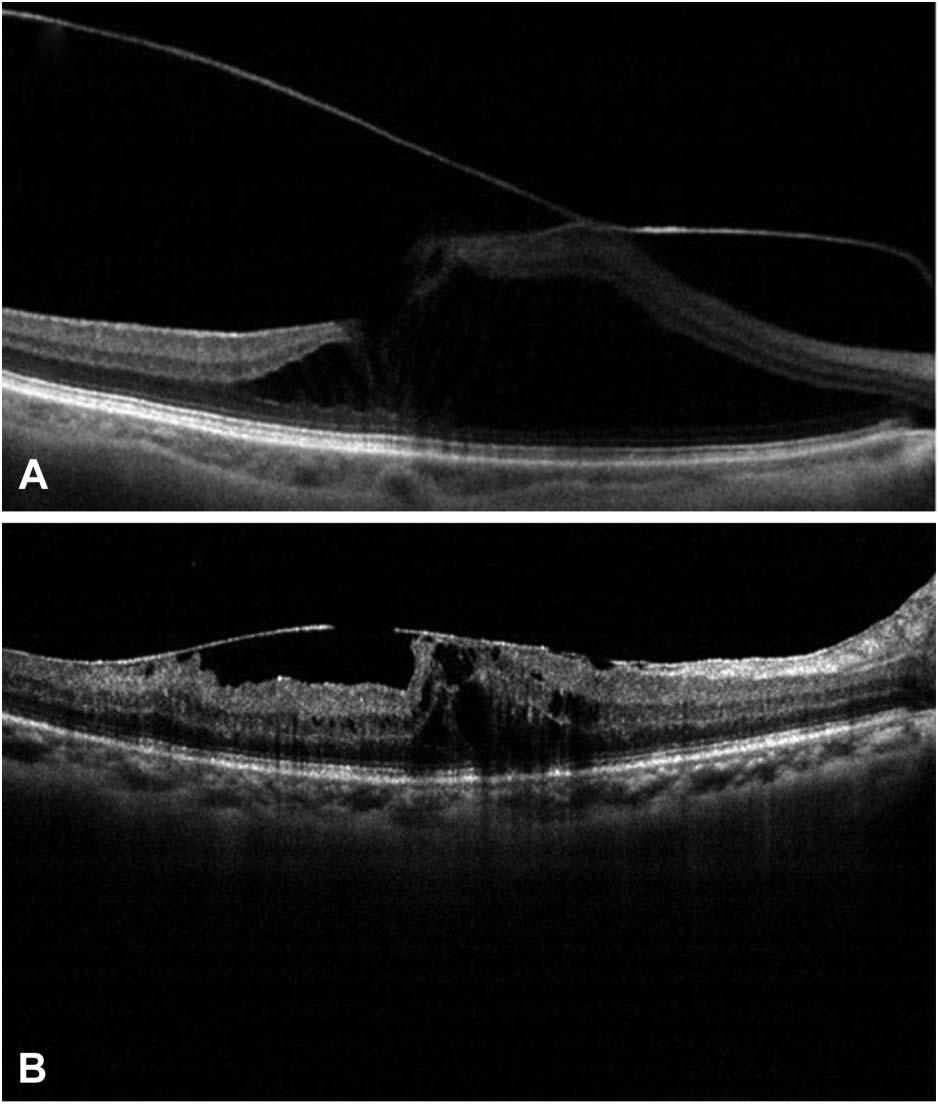 PREDICTIVE FACTORS OF VMT AFTER SURGERY YANG ET AL 1535 Results Fig. 1. Eyes with VMT were subclassified into two groups according to the diameter of vitreomacular adhesion based on SD-OCT. A. Focal type (Group 1) represents focal adhesion #1,500 mm, showing intraretinal cystoid edema and tractional macular schisis.