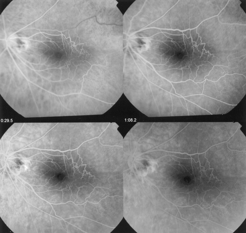 436 RETINA, THE JOURNAL OF RETINAL AND VITREOUS DISEASES 2002 VOLUME 22 NUMBER 4 Fig. 1. Example of a fluorescein angiogram in a patient with a macular pseudohole.