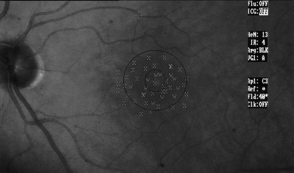 DEVELOPMENT OF MACULAR PSEUDOHOLES VARANO ET AL 437 Fig. 2. Example of scanning laser ophthalmoscope microperimetry in a healthy patient.