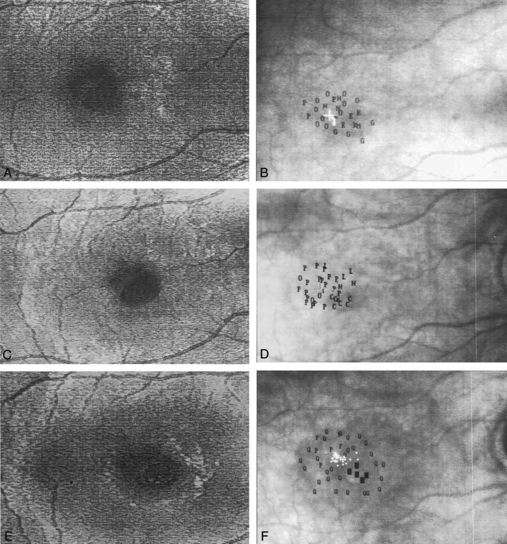 438 RETINA, THE JOURNAL OF RETINAL AND VITREOUS DISEASES 2002 VOLUME 22 NUMBER 4 Fig. 3.