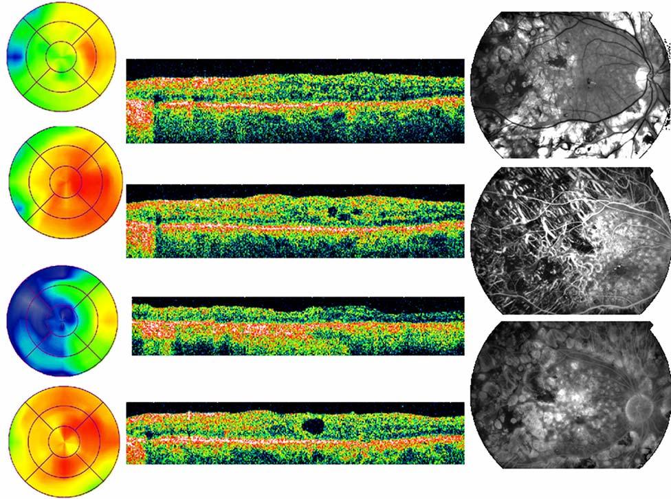 Interpreting Thickness Changes In The Diabetic Macula FIGURE 1 Case 1, right eye.