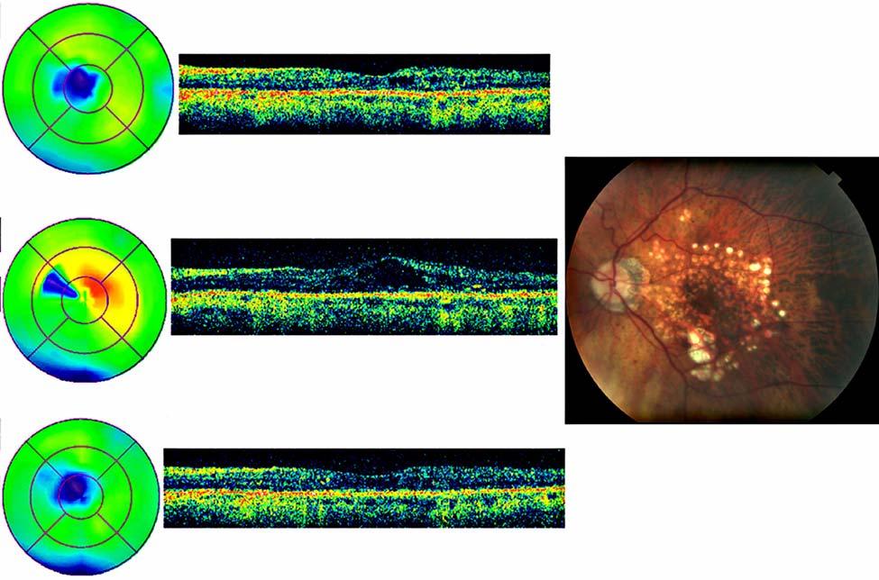 Browning The patient was observed without treatment, and at follow-up on November 11, 2008, he was noted to have spontaneous resolution of the macular thickening present at the previous examination