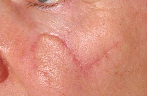 What will my scar look like? This will depend upon several things: Where on the body the wound is. Lumpy scars called keloids may result from operations.