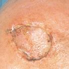 Possible complications of skin grafts Infection in the wound or breakdown of the graft may occur occasionally and when this happens then the surgical result may be poorer.