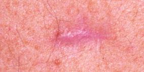 Diagnosis The diagnosis of melanoma is made by a specialist (usually a dermatologist or plastic surgeon), by looking at the skin. The diagnosis is confirmed, after removal, by the pathologist.