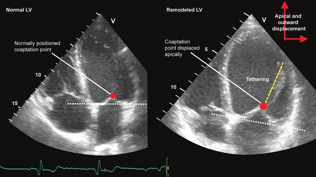 2 Section 2 Clinical Applications A Figure 1A and B: Systolic apical displacement of mitral leaflets and coaptation point relative to the annular