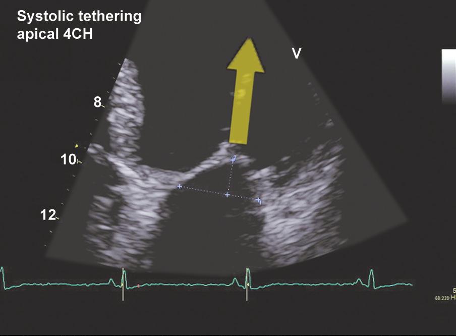 Figure 2: Systolic tethering of the MV leaflets which brings the leaflet coaptation line more apically into the LV cavity.