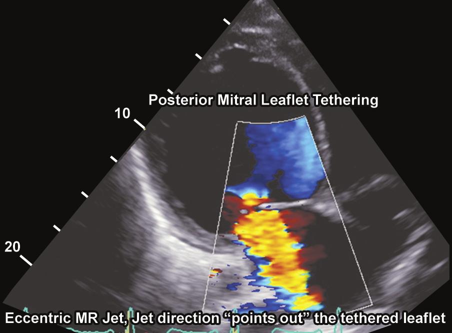 (A) Severe tethering of the anterior mitral leaflet with an eccentric jet (asymmetric tethering pattern) towards the interatrial septum; (B) Severe tethering of the posterior leaflet with an
