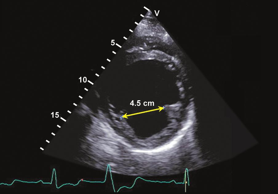33 Their incremental role compared to 2D echocardiography in predicting outcome after treatment in patients with chronic ischemic MR is still undefined.
