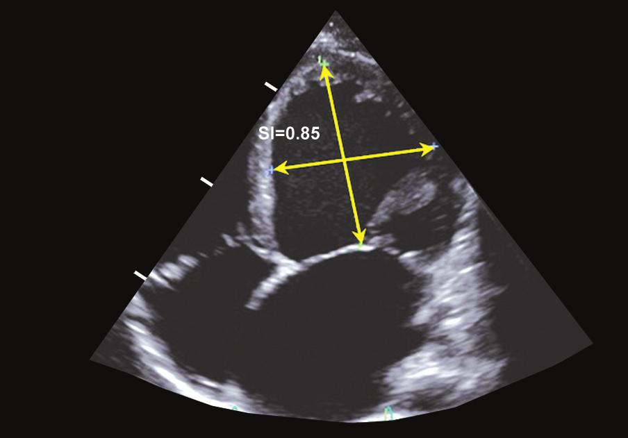The following parameters need to be reported: LV volumes, LV ejection fraction, wall motion abnormalities, LV systolic sphericity index (LV short axis-to-long axis diameter ratio measured at