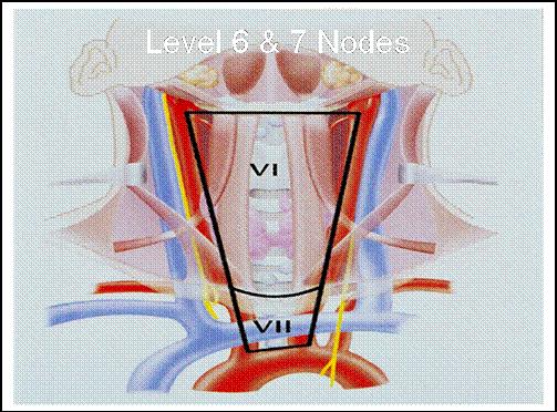 Management of + CA Total thyroidectomy with central node compartment dissection CND From hyod to superior medistinum Laterally to carotid sheath Routine selective or modified lymph node dissection