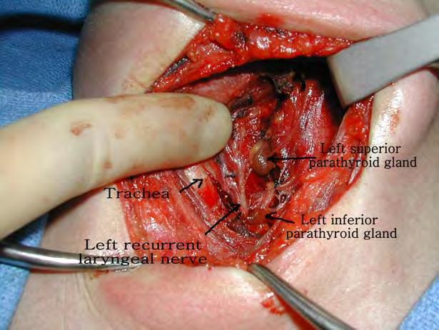 Postop Complication Recurrent nerve palsy External branch laryngeal nerve palsy
