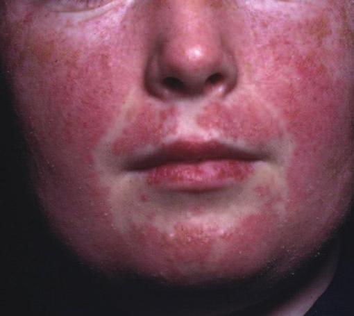 2 ABC of Dermatology Figure 1.3 Seborrhoeic keratoses. Figure 1.2 Lupus erythematosus. Box 1.1 Dermatology history-taking Where? Site of initial lesion(s) and subsequent distribution How long?
