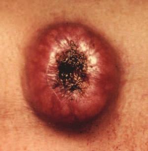 0 cm in diameter (Figure 1.7). A nodule (Figure 1.8) is similar to a papule but greater than 1.0 cm in diameter. A vascular papule or nodule is known as a haemangioma. A plaque (Figure 1.