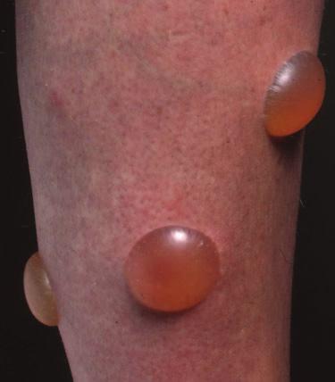 Nummular literally means a coin-like lesion (Figure 1.14). There is no hard and fast distinction from discoid lesions, which are flat disc-like lesions of variable size.