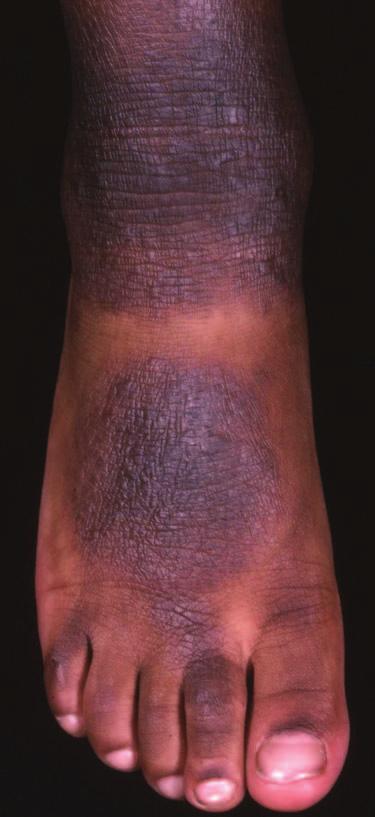 The term pustule is applied to lesions containing purulent material which may be due to infection or sterile pustules (inflammatory polymorphs) (Figure 1.15) which are seen in pustular psoriasis.