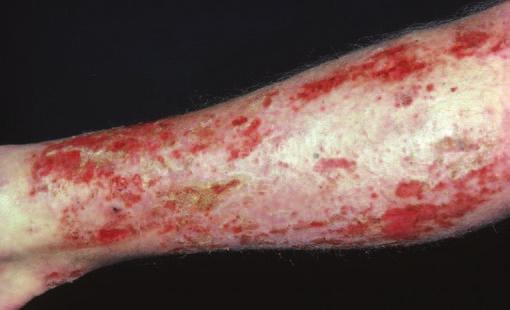 6 ABC of Dermatology Figure 1.19 Excoriation of epidermis. Figure 1.21 Desquamation. Figure 1.22 Ring-shaped annular lesion. Figure 1.20 Hyperkeratosis with fissures.