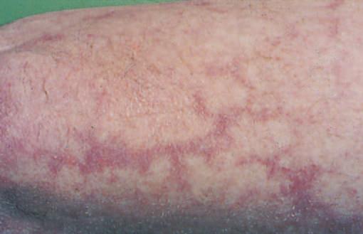specific conditions. There may be a history of recurrent episodes such as occurs in atopic eczema due to the patient s constitutional tendency.