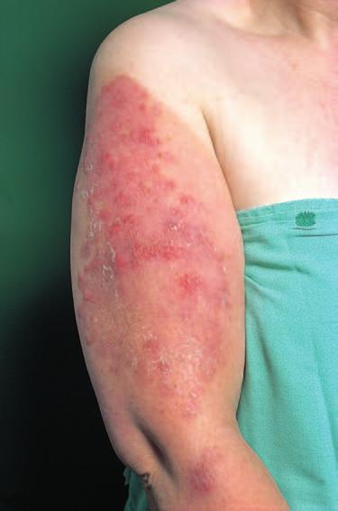 Recurrences of the rash, particularly in specific situations, suggest a contact dermatitis. Similarly a rash that only occurs in the summer months may well have a photosensitive basis (Figure 1.27).