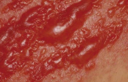 Visually you may see scaling, thickening, increased skin markings, small vesicles, crusting, erosions or desquamation.