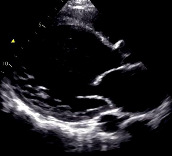 - Case (2) - 55-year-old female with non-ischemic dilated cardiomyopathy with severe LV