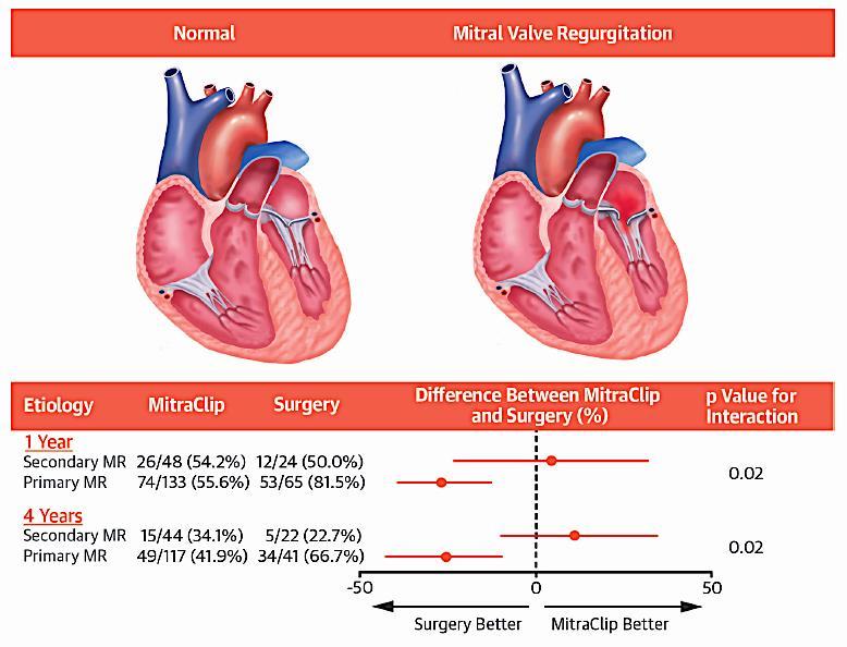 Randomized Comparison of Percutaneous Repair and Surgery for Mitral Regurgitation - 5-year results of the EVEREST II trial - Secondary MR in heart failure: Interaction