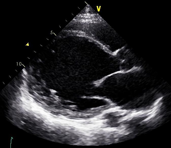 - Case (2) - 55-year-old female with non-ischemic dilated