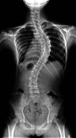 Simple Rod Rotation for Adolescent Idiopathic Scoliosis JY Kim, et al. A C E study. The mean age was 16.2 years (range of 13 24) at first visit our hospital and 16.4 years (range of 13 25) at surgery.