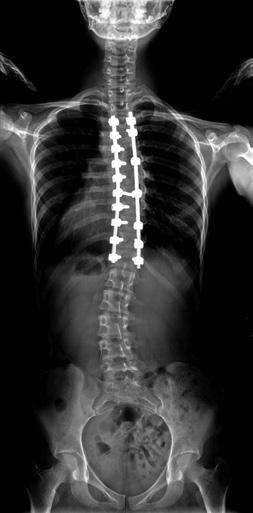 Thoracic or thoracolumbar kyphosis, and bone maturation using a Risser grade were also checked. Vertebral body rotation is measured in the axial plane of computed tomography (CT) 6).